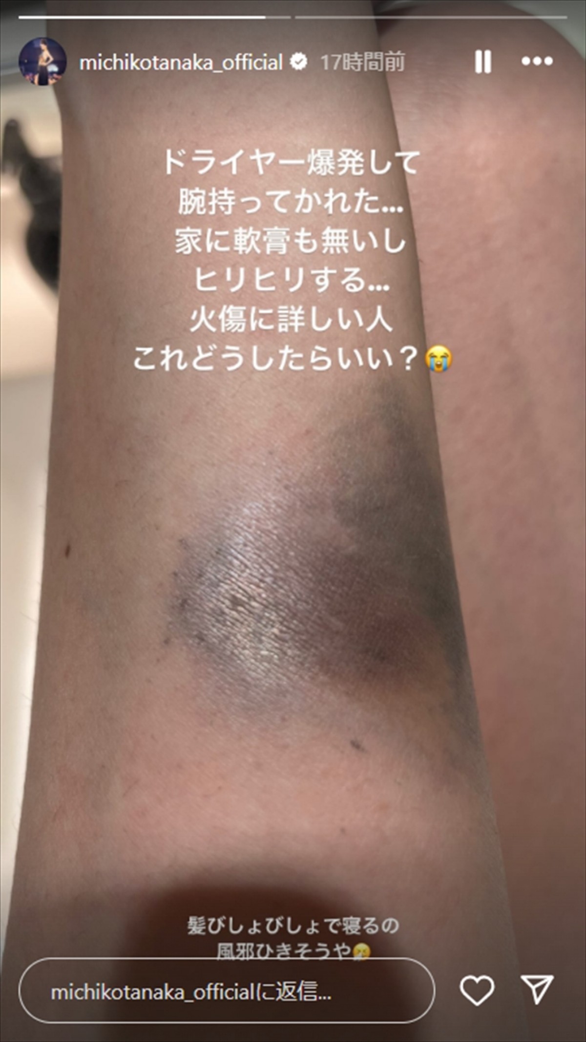 人気女優「ドライヤー爆発して」火傷で腕が黒ずみ、痛々しい投稿に心配の声　本人は「これどうしたらいい？」