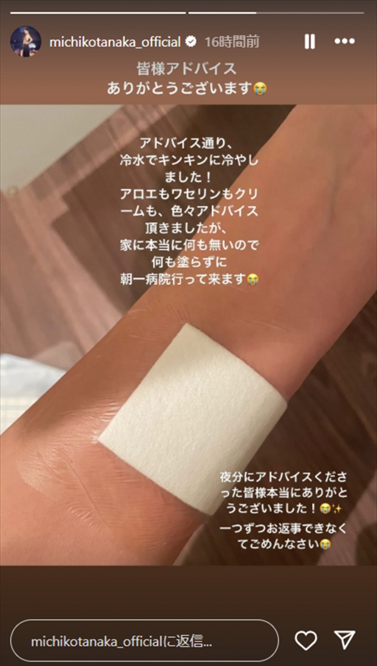 人気女優「ドライヤー爆発して」火傷で腕が黒ずみ、痛々しい投稿に心配の声　本人は「これどうしたらいい？」